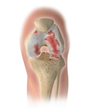 Schematische slijtage knie