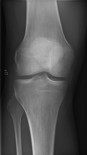 Voor-aanzicht knie rontgenfoto