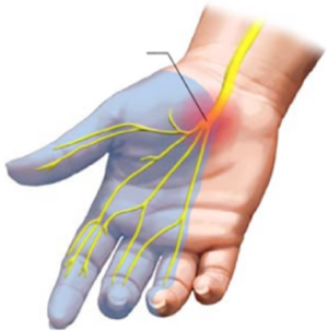 Tunnel Syndroom (CTS) - Eisenhower Kliniek